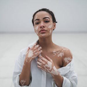 cómo tratar el vitiligo