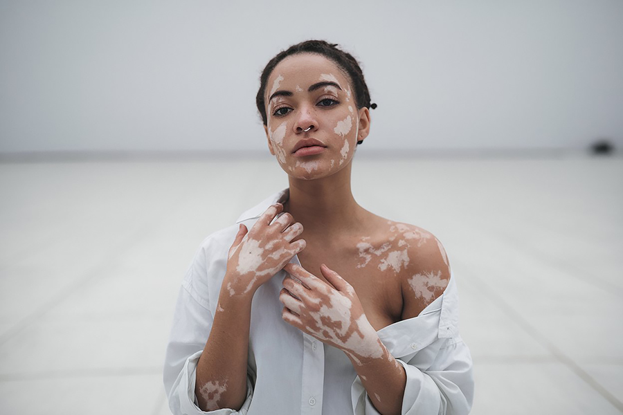 cómo tratar el vitiligo