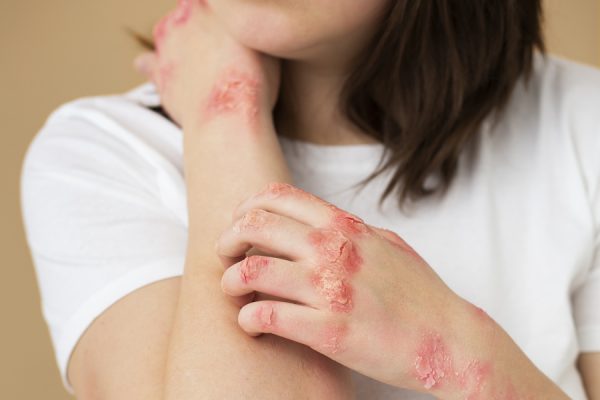 Fototerapia para los brotes de psoriasis del otoño