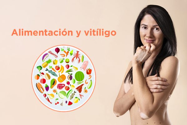 Importancia de la nutrición en el manejo del vitiligo