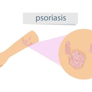 salud de la piel psoriasis