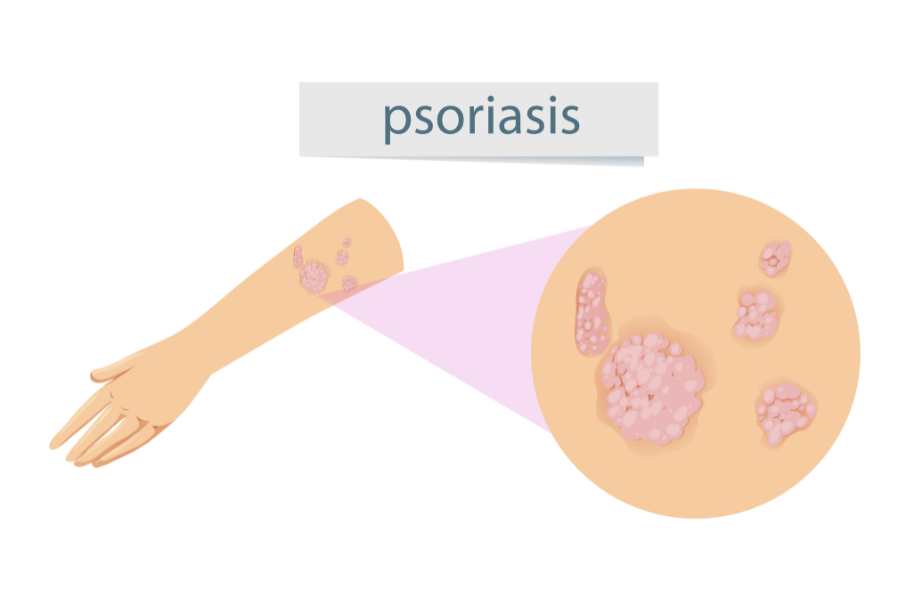 salud de la piel psoriasis