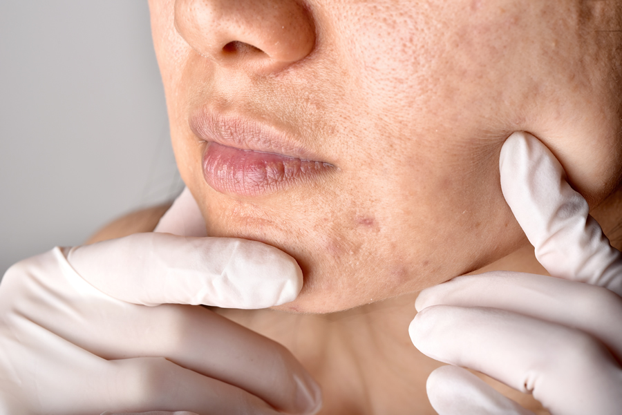 Sabes cuál es tu tipo de acné Repasamos las diferentes clases